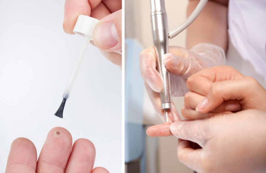 Средство от бородавок: список эффективных медикаментов и народных средств для удаления бородавки (105 фото + видео)