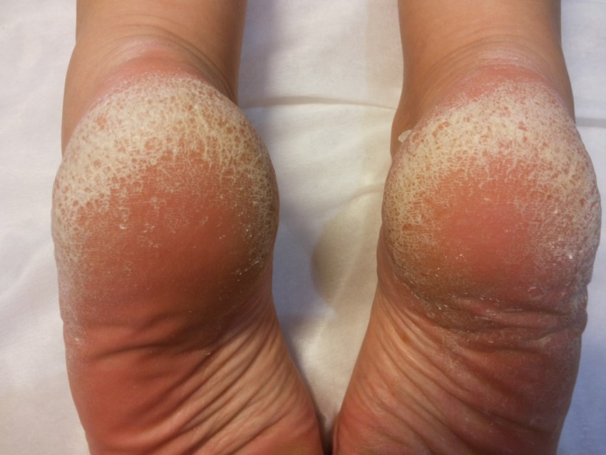 Средство от грибка: обзор самых эффективных лекарств и средств для устранения грибкового заболевания (150 фото и видео)