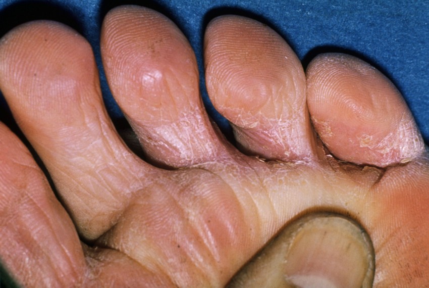 Средство от грибка: обзор самых эффективных лекарств и средств для устранения грибкового заболевания (150 фото и видео)