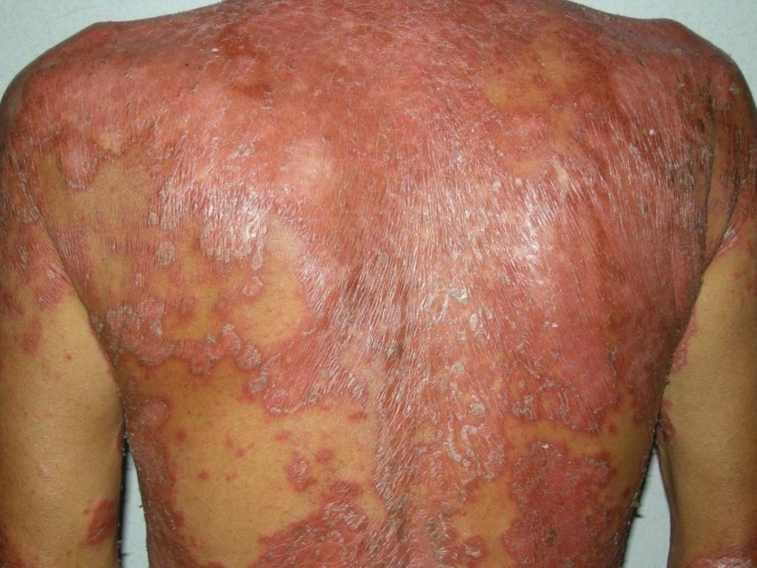 Стадии псориаза: причины возникновения и развитие болезни. Советы дерматологов по диагностике и лечению заболевания (115 фото и видео)