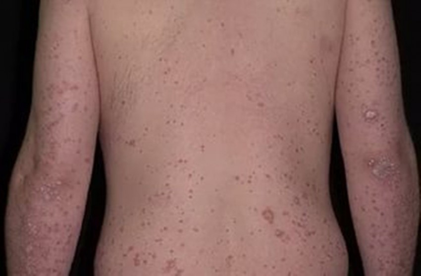 Стадии псориаза: причины возникновения и развитие болезни. Советы дерматологов по диагностике и лечению заболевания (115 фото и видео)