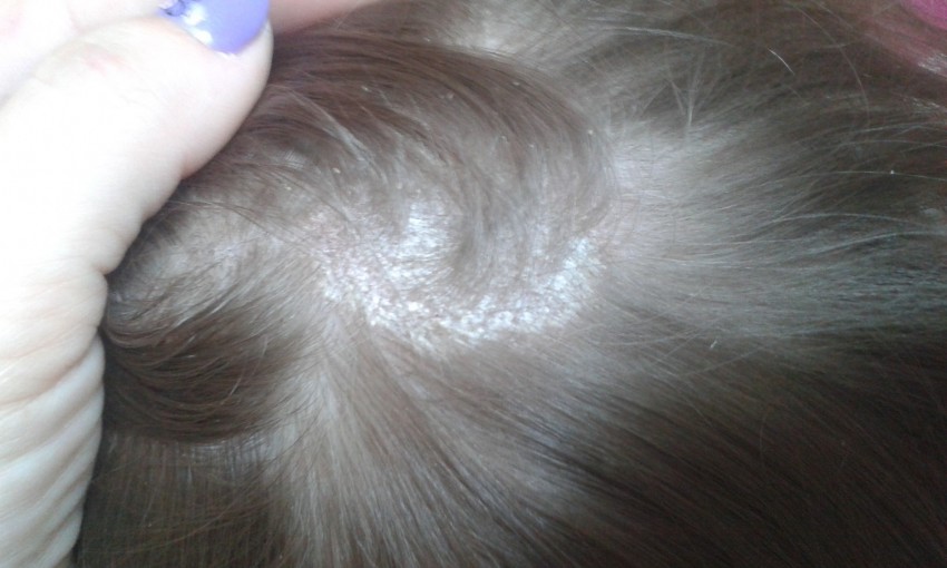 Стригущий лишай - симптомы, развитие, виды, советы как быстро и эффективно вылечить в домашних условиях (105 фото и видео)