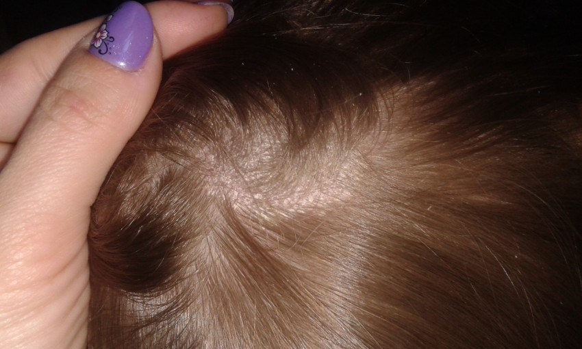 Стригущий лишай - симптомы, развитие, виды, советы как быстро и эффективно вылечить в домашних условиях (105 фото и видео)