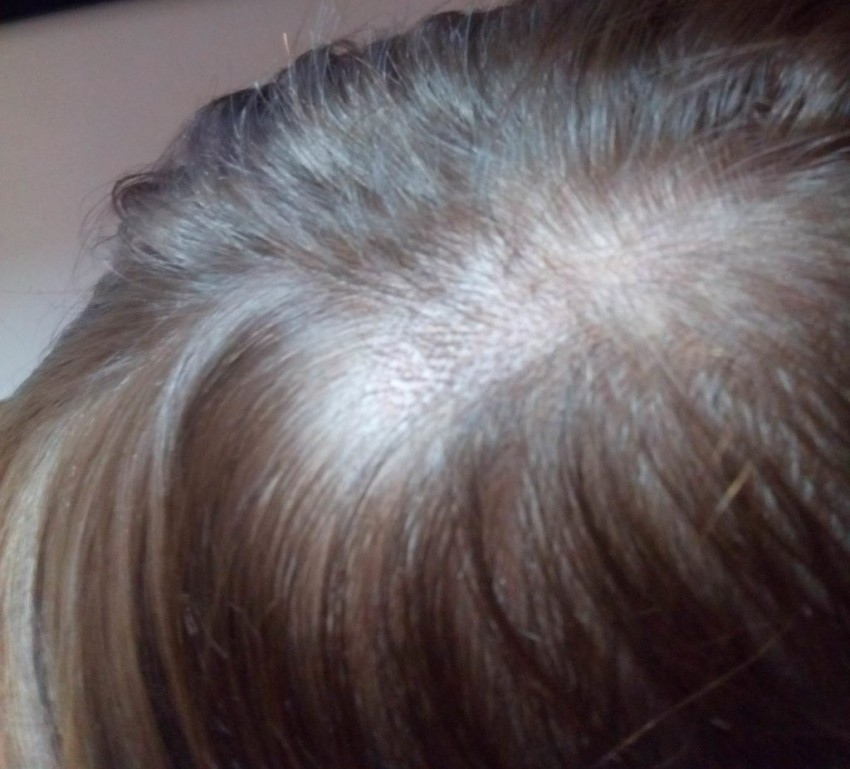 Стригущий лишай - симптомы, развитие, виды, советы как быстро и эффективно вылечить в домашних условиях (105 фото и видео)