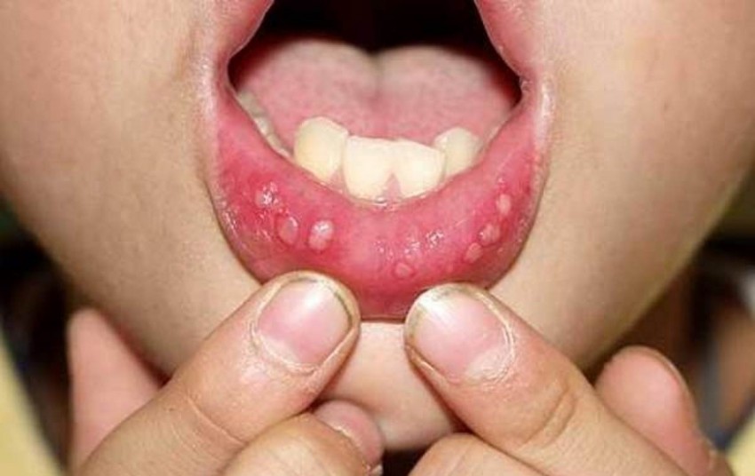 Типы герпеса: основные виды, проявления, симптомы и методика лечения заболевания (105 фото и видео)