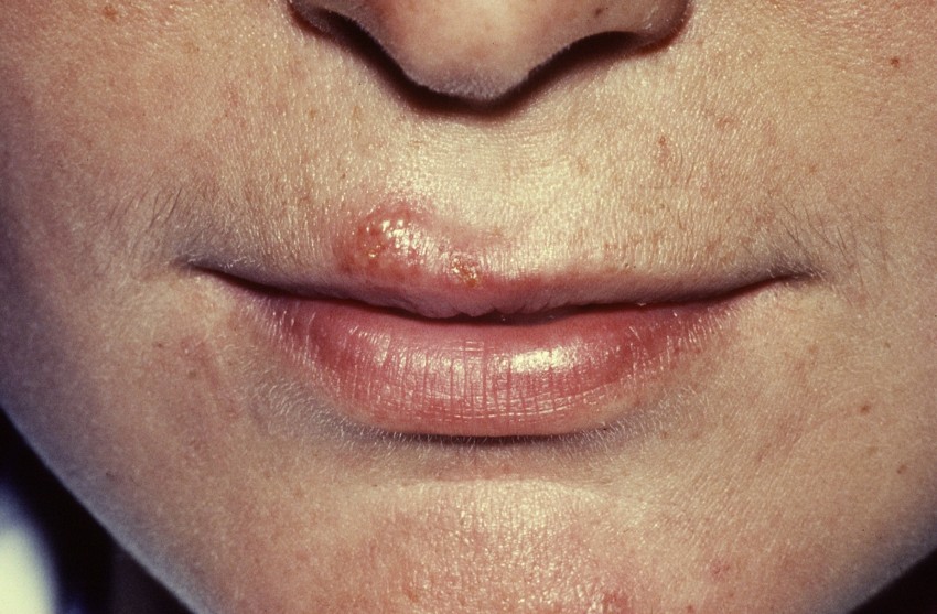 Типы герпеса: основные виды, проявления, симптомы и методика лечения заболевания (105 фото и видео)