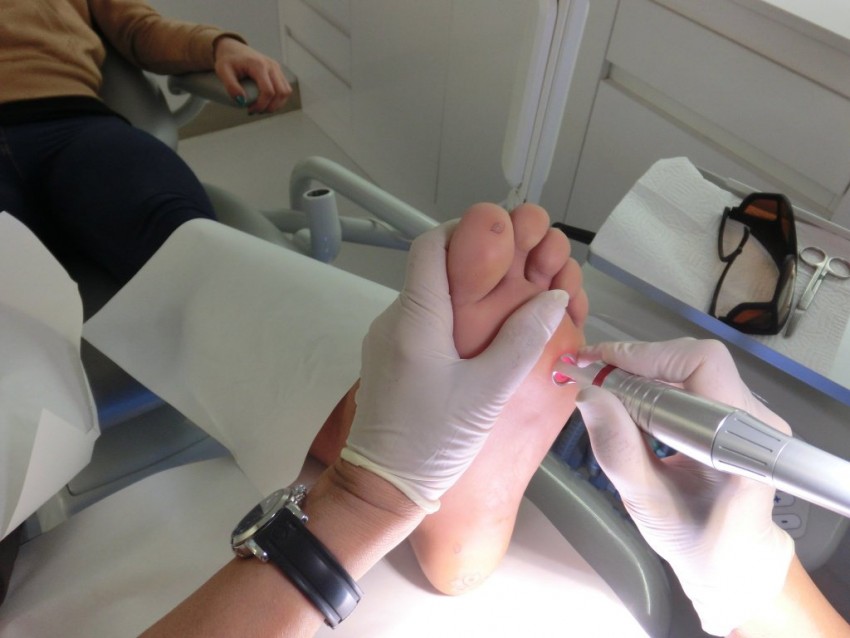 Удаление бородавок - способы, методы, цены, эффективность и противопоказания к удалению (видео + 130 фото)