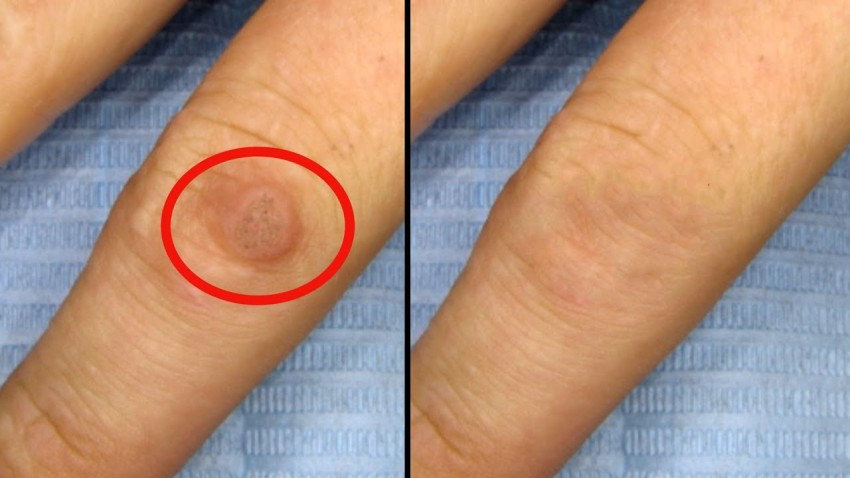 Удаление бородавок - способы, методы, цены, эффективность и противопоказания к удалению (видео + 130 фото)