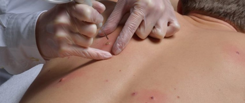 Удаление бородавок лазером - описание процедуры, советы по выбору специалиста, цены, эффективность и отзывы врачей (135 фото и видео)