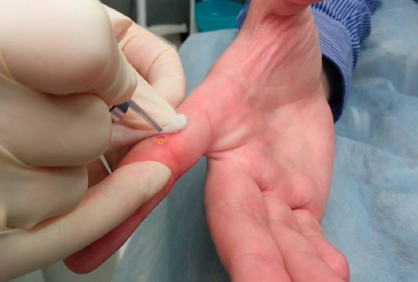 Удаление бородавок жидким азотом - эффективность криодеструкции, последствия и альтернативы процедуры (110 фото и видео)