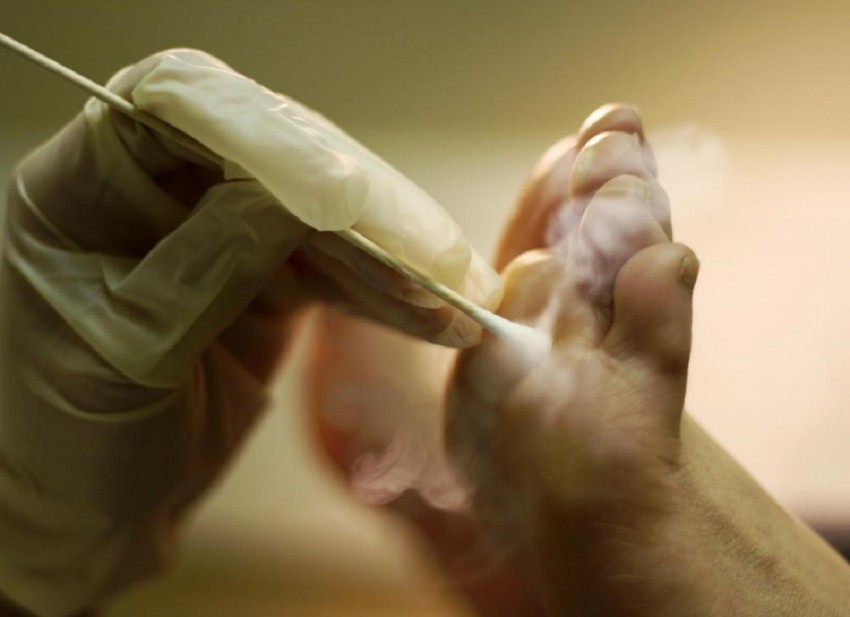 Удаление бородавок жидким азотом - эффективность криодеструкции, последствия и альтернативы процедуры (110 фото и видео)