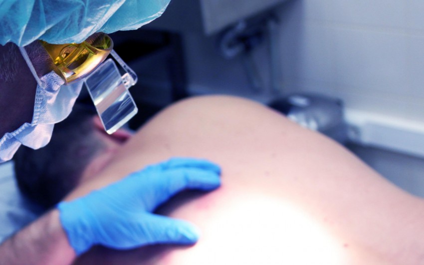 Удаление бородавок жидким азотом - эффективность криодеструкции, последствия и альтернативы процедуры (110 фото и видео)