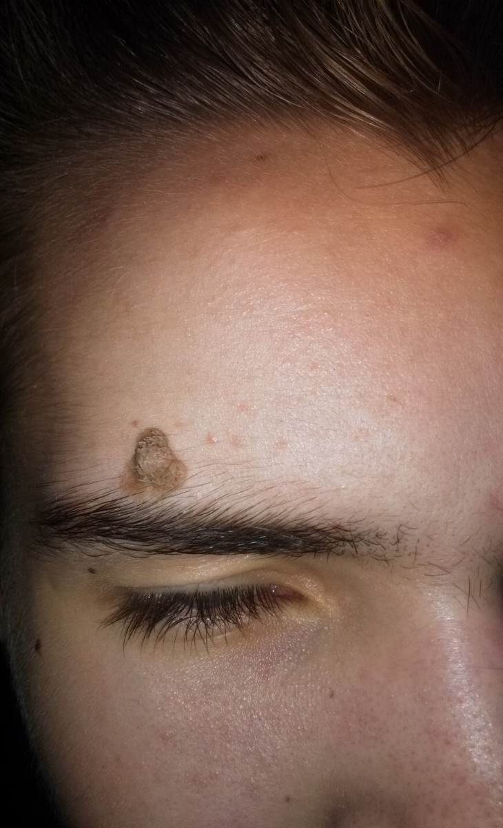 Удаление родинок - методы, варианты и правила избавления от родинок. Диагностика и оценка родинок (100 фото и видео)