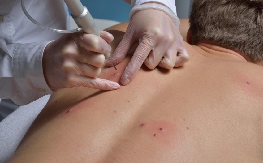 Удаление родинок - методы, варианты и правила избавления от родинок. Диагностика и оценка родинок (100 фото и видео)