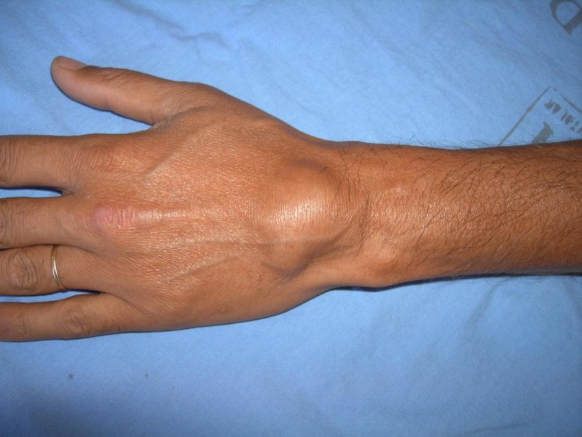 Удаление жировика: поэтапное описание операции, эффективные методы послеоперационного ухода и рекомендации врачей по удалению жировика (140 фото)