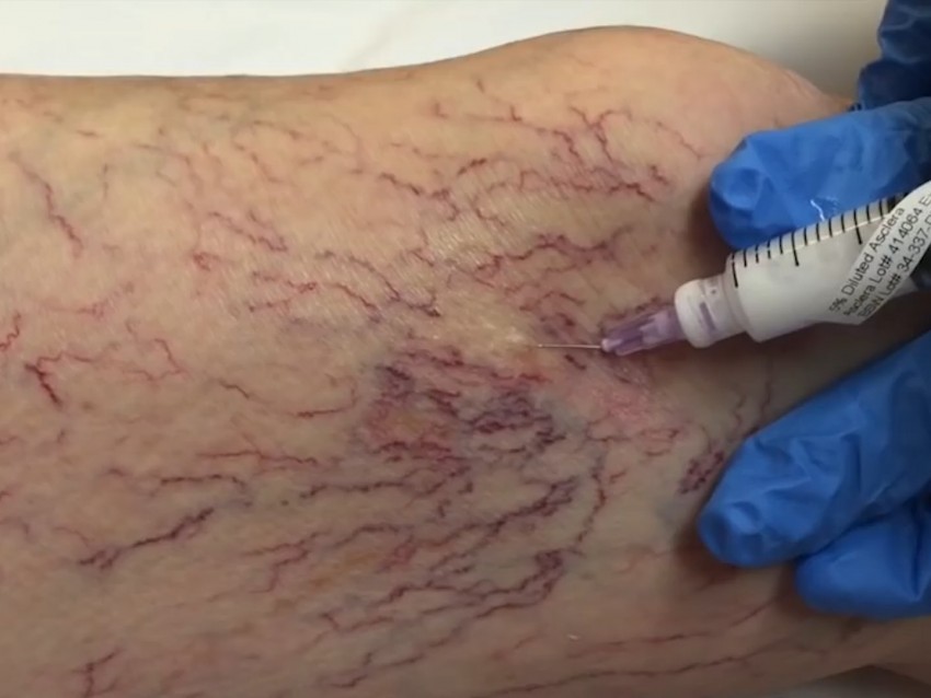 Варикоз на ногах: симптомы, проявления, методика лечения и советы опытных врачей по профилактике заболевания (125 фото и видео)