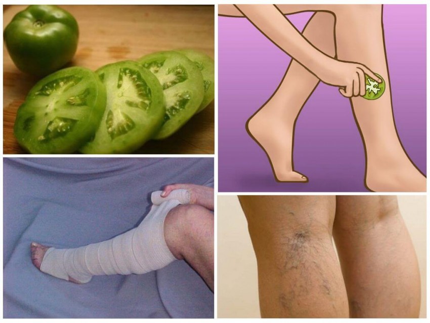 Варикоз на ногах: симптомы, проявления, методика лечения и советы опытных врачей по профилактике заболевания (125 фото и видео)