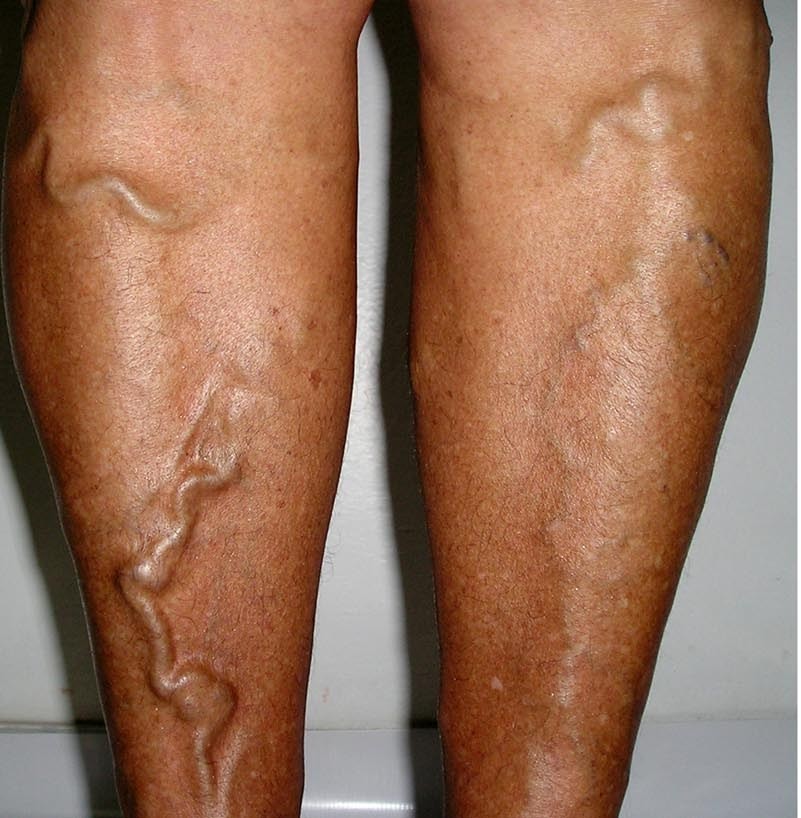 Варикоз на ногах: симптомы, проявления, методика лечения и советы опытных врачей по профилактике заболевания (125 фото и видео)