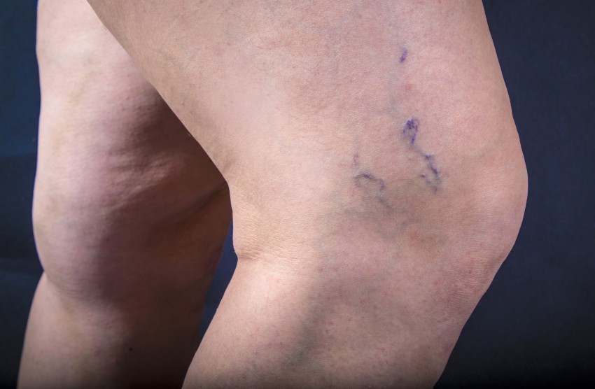 Варикоз на ногах: симптомы, проявления, методика лечения и советы опытных врачей по профилактике заболевания (125 фото и видео)