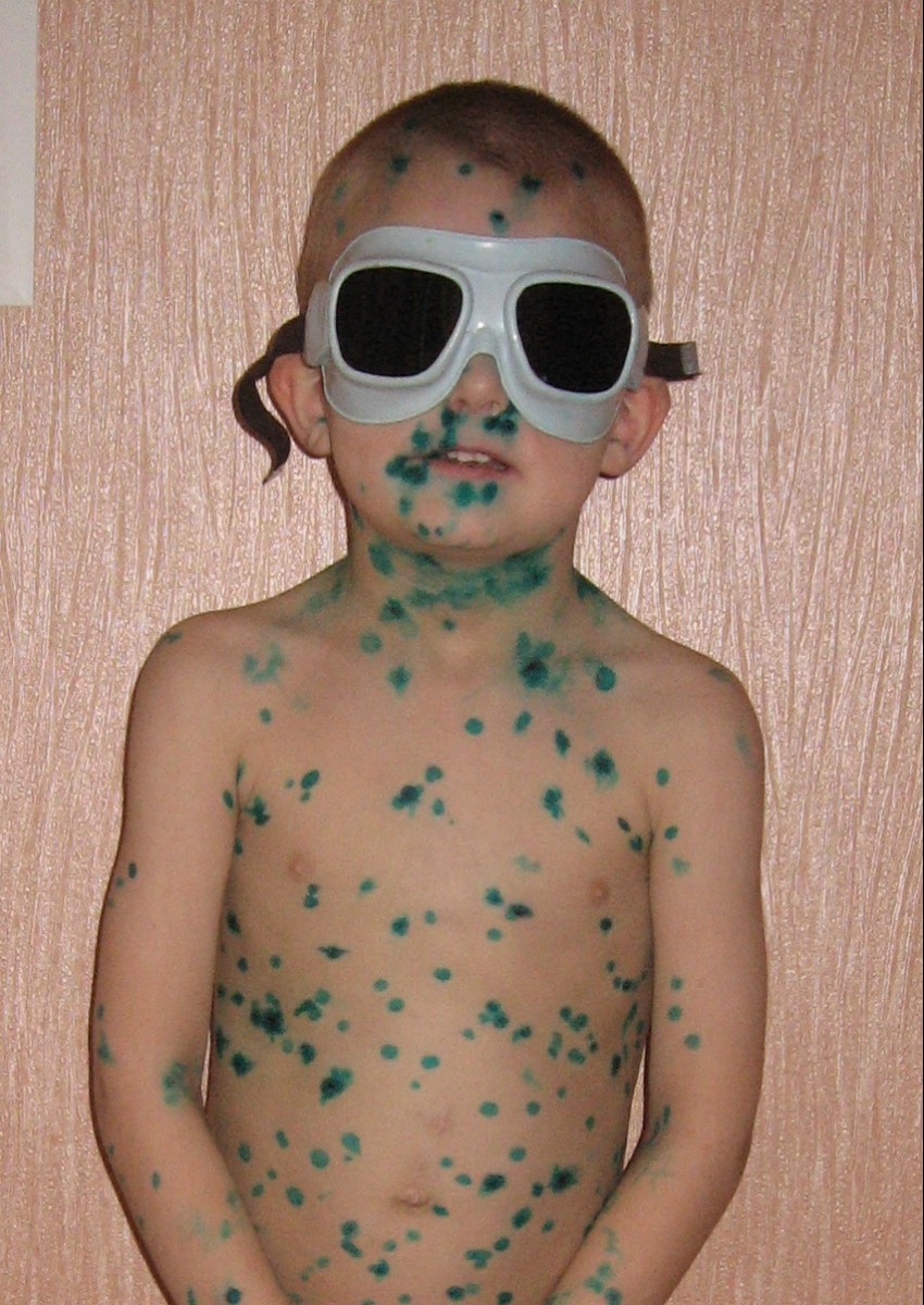 Ветрянка у детей - 150 фото, симптомы, лечение и распространенные методы профилактики. Советы дерматологов как вылечить ветрянку