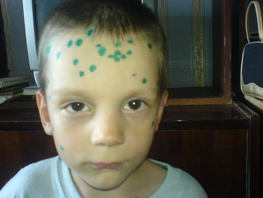 Ветрянка у детей - 150 фото, симптомы, лечение и распространенные методы профилактики. Советы дерматологов как вылечить ветрянку