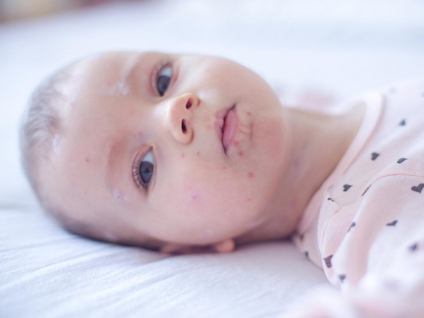 Ветрянка у детей - 150 фото, симптомы, лечение и распространенные методы профилактики. Советы дерматологов как вылечить ветрянку