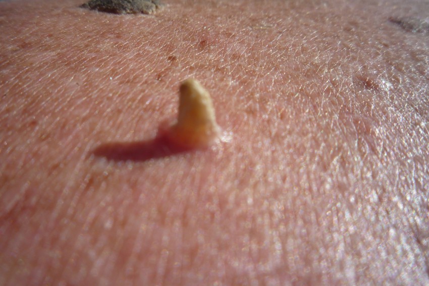 Виды бородавок: причины появления, 140 фото разновидностей и советы врачей по их удалению