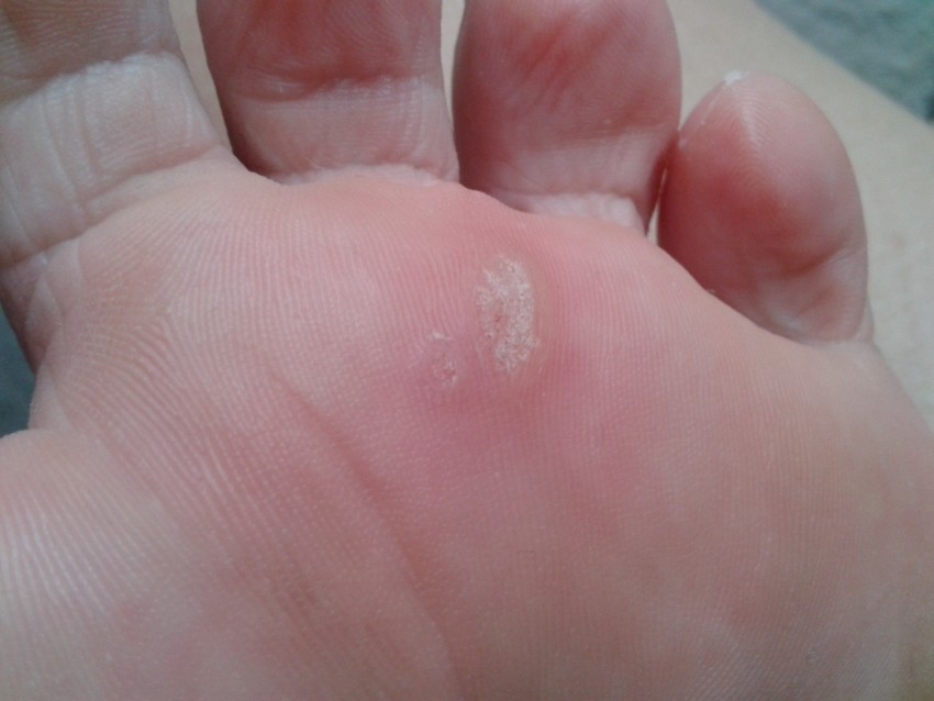 Виды бородавок: причины появления, 140 фото разновидностей и советы врачей по их удалению