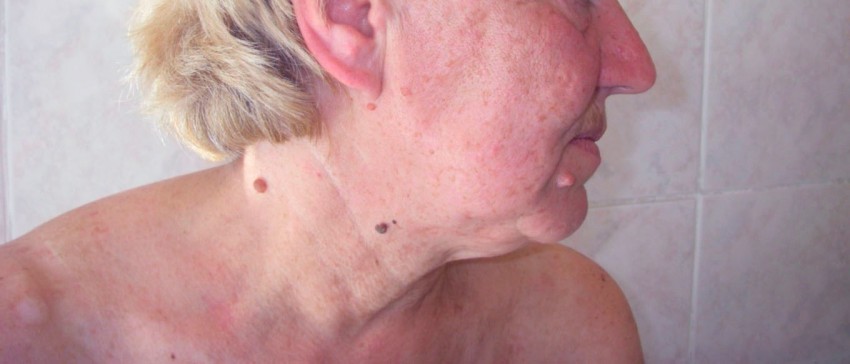 Виды бородавок: причины появления, 140 фото разновидностей и советы врачей по их удалению