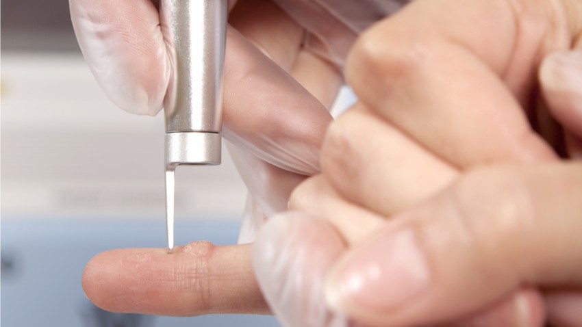 Виды бородавок: причины появления, 140 фото разновидностей и советы врачей по их удалению