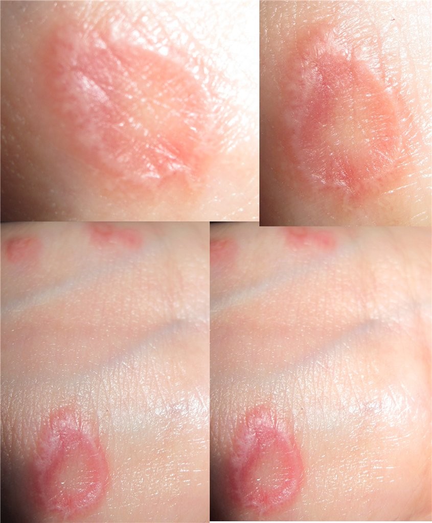 Виды лишая: 110 фото, медицинское описание, первые признаки и методы лечения заболевания