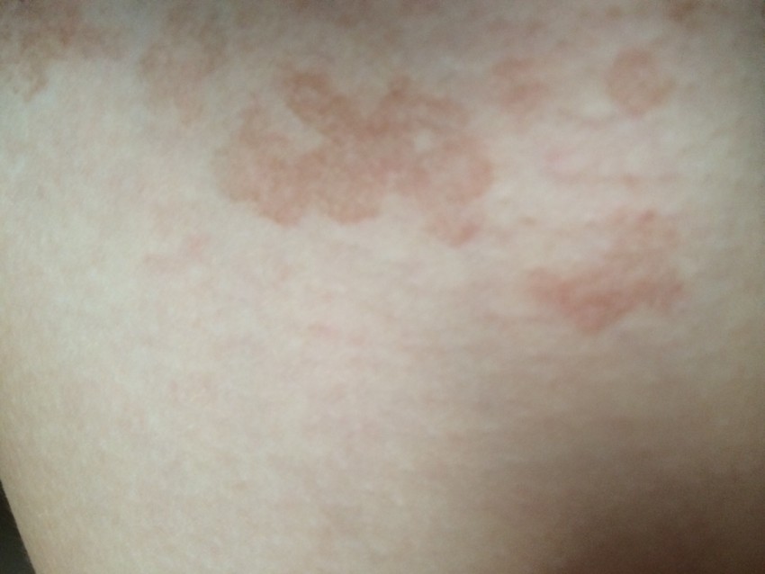 Виды лишая: 110 фото, медицинское описание, первые признаки и методы лечения заболевания