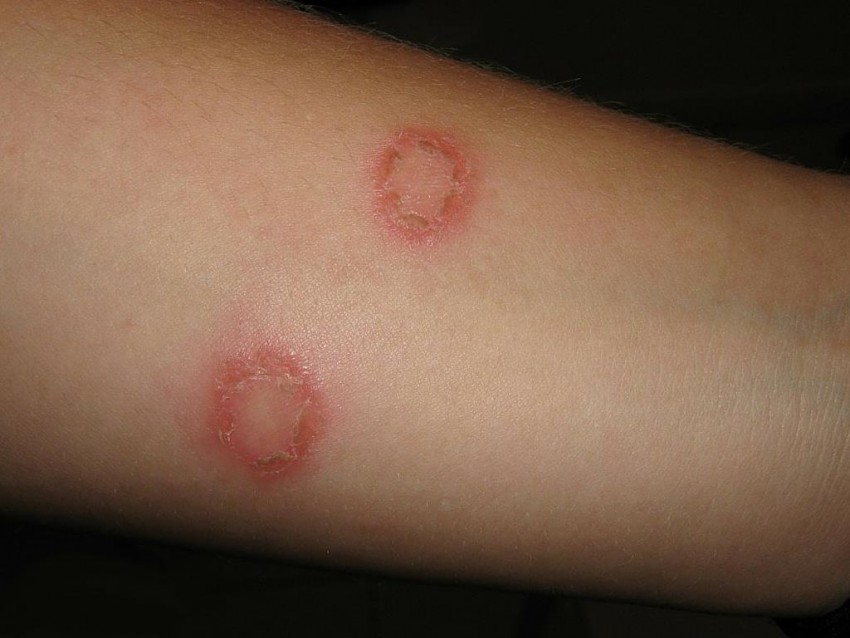 Виды лишая: 110 фото, медицинское описание, первые признаки и методы лечения заболевания