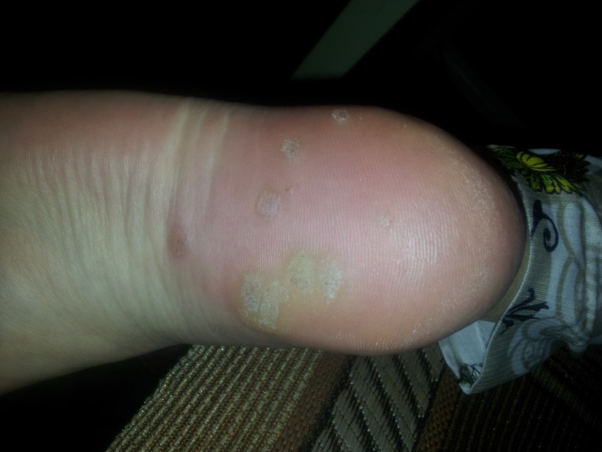 Вирусные бородавки - описание, свойства, причины, лечение и удаление бородавок (90 фото + видео)