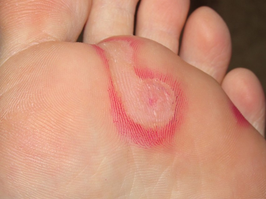 Вирусные бородавки - описание, свойства, причины, лечение и удаление бородавок (90 фото + видео)