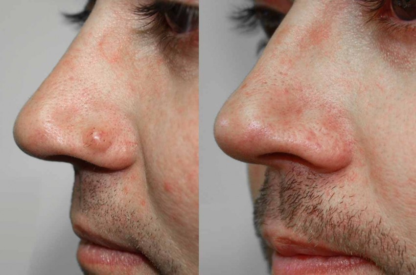 Вирусные бородавки - описание, свойства, причины, лечение и удаление бородавок (90 фото + видео)