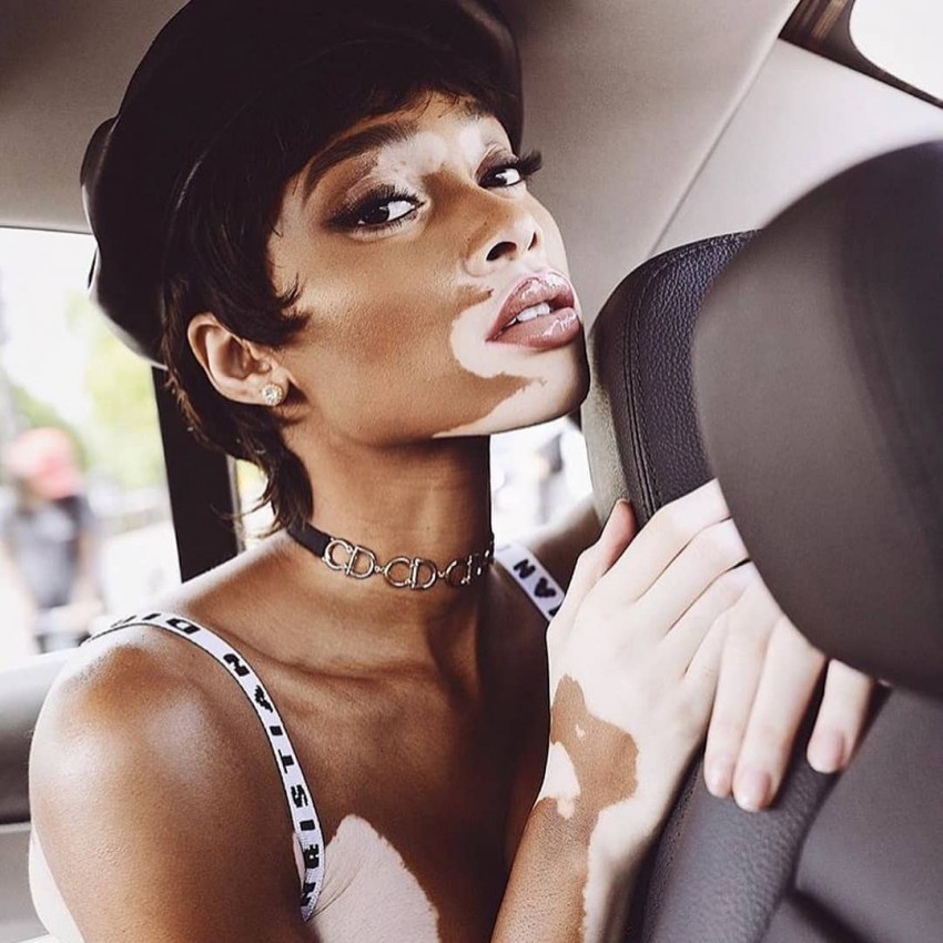 Витилиго - причины появления, симптомы, виды, диагностика и лечение в клинике и в домашних условиях (видео + 135 фото)