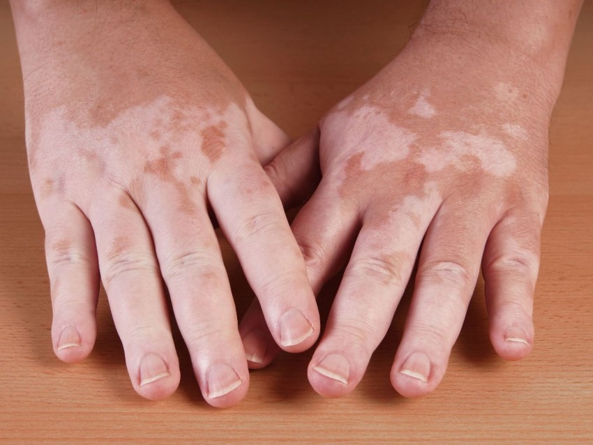 Витилиго - причины появления, симптомы, виды, диагностика и лечение в клинике и в домашних условиях (видео + 135 фото)