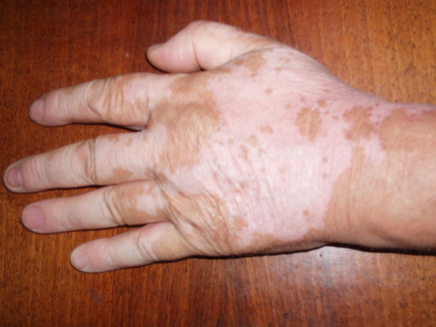 Витилиго - причины появления, симптомы, виды, диагностика и лечение в клинике и в домашних условиях (видео + 135 фото)
