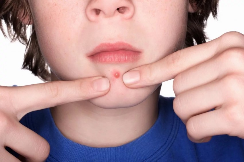 Внутренний прыщ - причины образования, советы специалистов по избавлению и рекомендации по выбору метода лечения (75 фото)