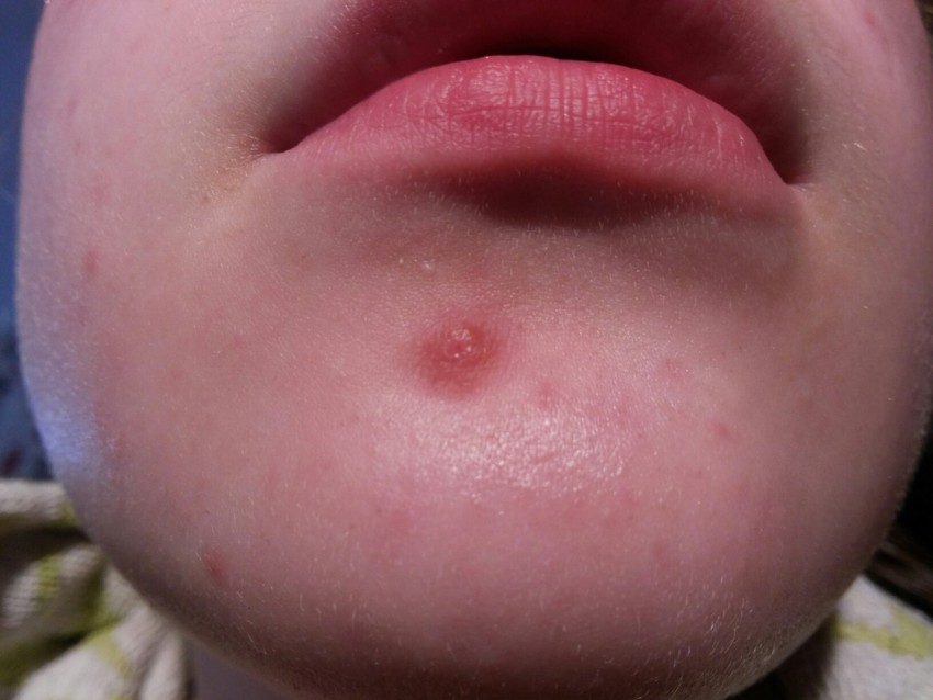 Внутренний прыщ - причины образования, советы специалистов по избавлению и рекомендации по выбору метода лечения (75 фото)