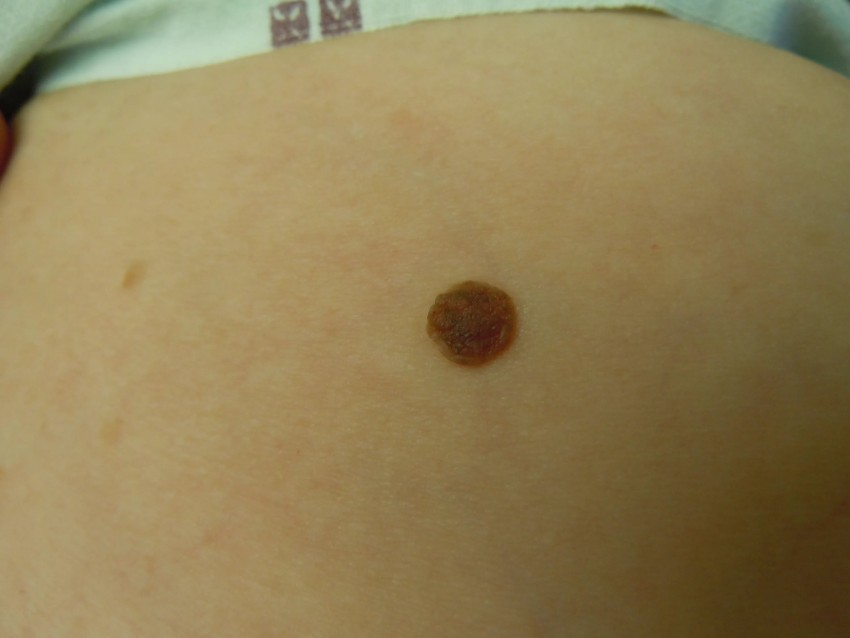Волосы на родинке - почему на родинке появляются волосы и как их безопасно удалить? (75 фото и видео)