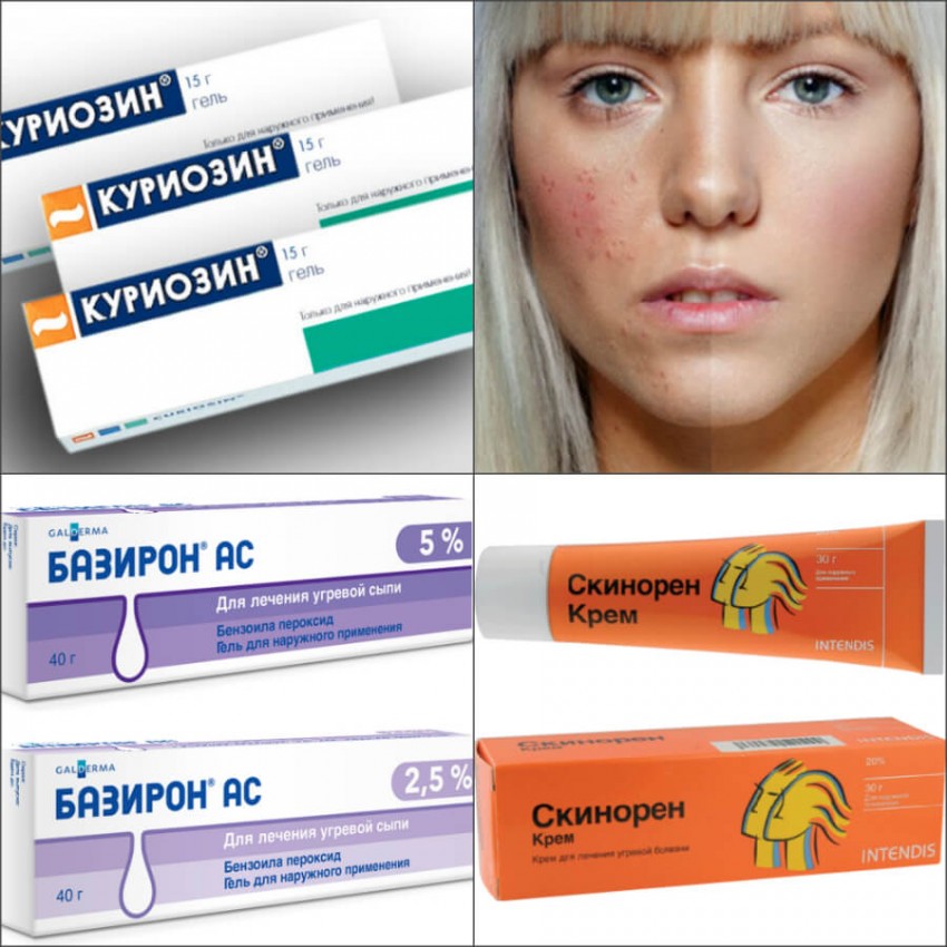 Высыпали прыщи: поиск причины, выбор средства для удаления, советы и лучшие средства по уходу за кожей (70 фото)