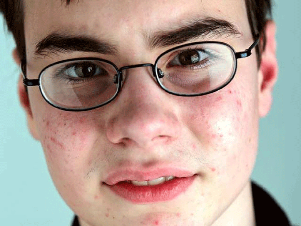 Высыпали прыщи: поиск причины, выбор средства для удаления, советы и лучшие средства по уходу за кожей (70 фото)