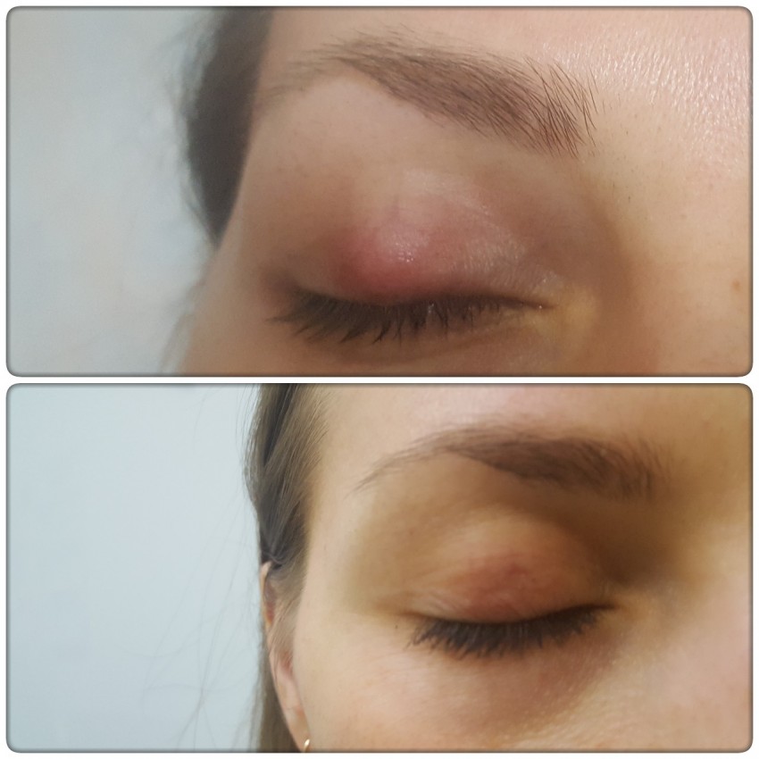 Жировики на теле - причины появления и к кому обращаться с проблемой. 130 фото и видео лечения и удаления жировика