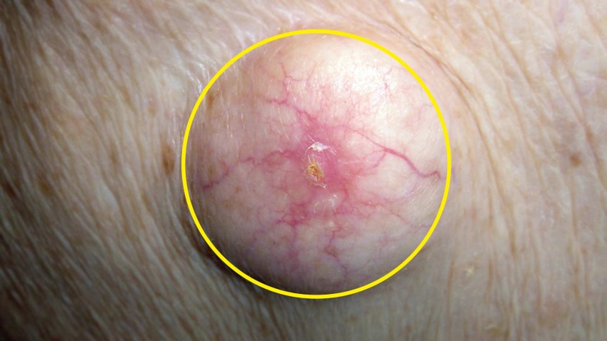 Жировики на теле - причины появления и к кому обращаться с проблемой. 130 фото и видео лечения и удаления жировика