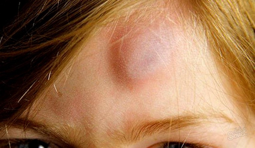 Жировики на теле - причины появления и к кому обращаться с проблемой. 130 фото и видео лечения и удаления жировика