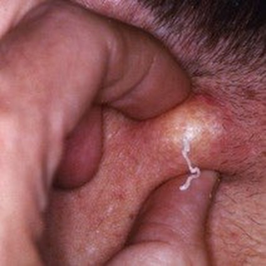 Жировики на теле - причины появления и к кому обращаться с проблемой. 130 фото и видео лечения и удаления жировика