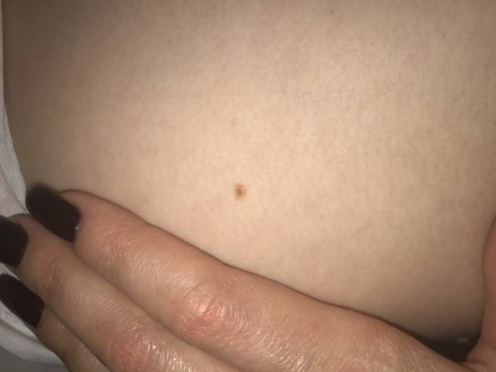 Значение родинок - исследование, необходимость удаления и механизм оценки родинки (100 фото)