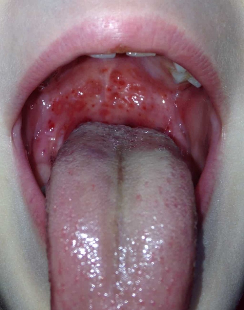 Аллергия у ребенка (75 фото): первые признаки, советы врачей по поиску причины, экстренные ситуации, варианты снятия отечностей и методика лечения аллергии